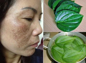 Tiết lộ cách trị nám tàn nhang hiệu quả với lá trầu không ngay tại nhà
